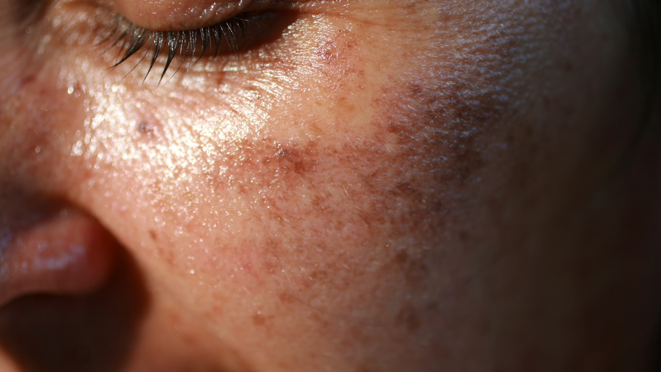 sun spots on the skin